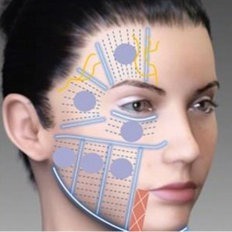 HIFU plasztika helyett! Arc + Toka + Nyak + Dekoltázs is!