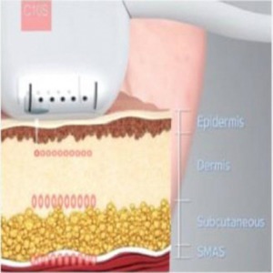 HIFU plasztika helyett! Arc + Toka + Nyak + Dekoltázs is!