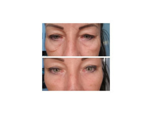 InstanTENSE Plus emelő hatású szérum (25 ml)